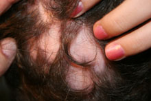 ochagovaya_alopeciya3.jpg