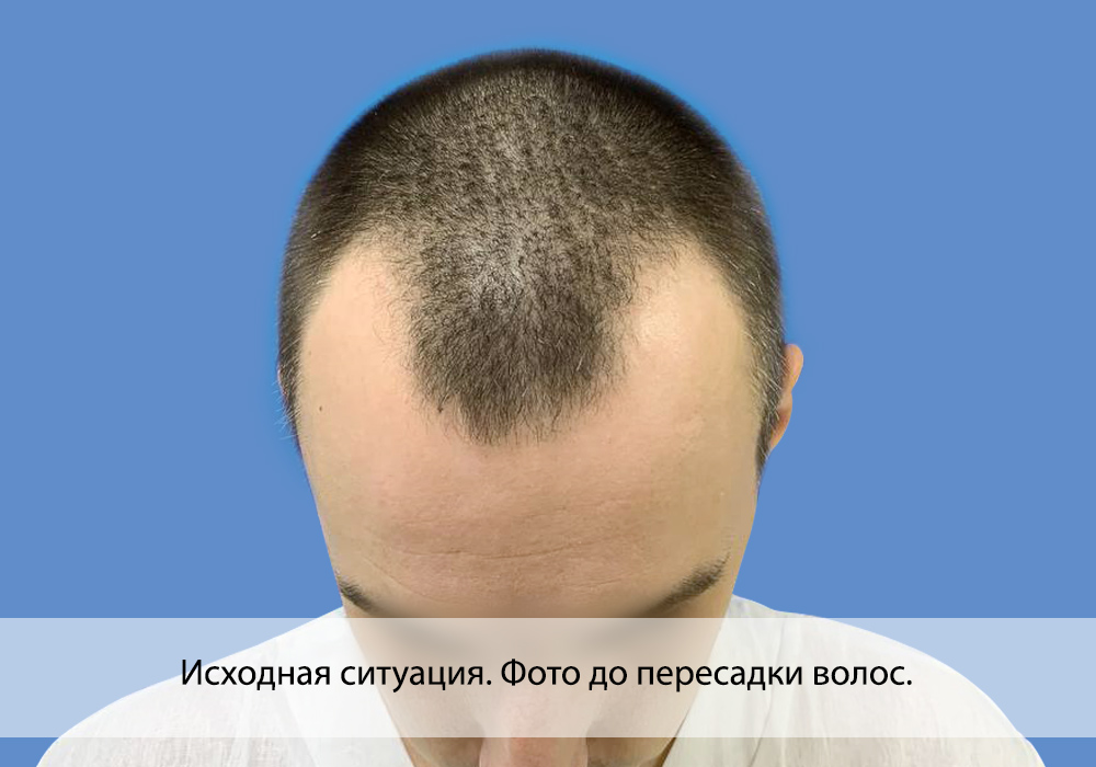 Пересадка волос цена для мужчин 2024