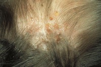Болячки на голове - фотографии и рекомендации по лечению - Клиника «Доктор  Волос»