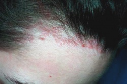 Аллергический дерматит кожи головы