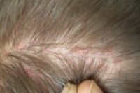 Прыщи и угри на коже головы: цены на лечение в Москве - Клиника «Доктор  Волос»