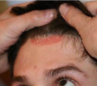 Контактный дерматит кожи головы