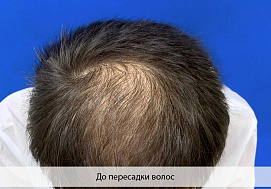 Пересадка волос